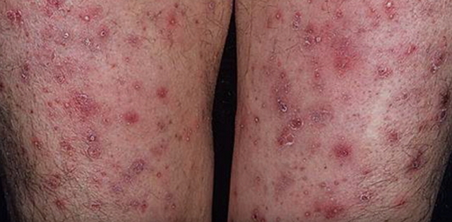 Чим небезпечний варикозний дерматит і чи можна його вилікувати самостійно?