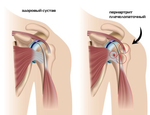 Симптомы и лечение периартрита плечевого сустава