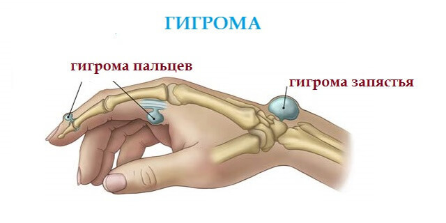 Гігрома зап'ястя лікування без операції