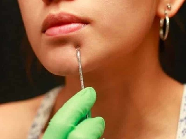 Чорні точки на носі: домашні методи лікування і профілактики