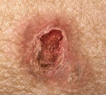 Рак шкіри: види, симптоми, способи лікування