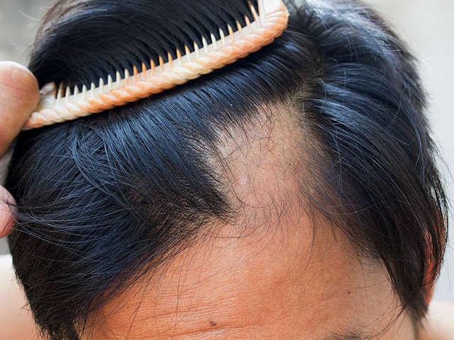 Випадання волосся причини і лікування у жінок