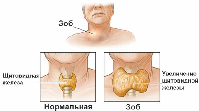 Кашель при щитовидці, симптоми захворювання і методи терапії кашлю