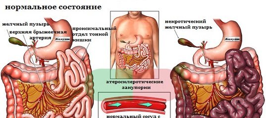 Симптоми і лікування ішемії кишечника