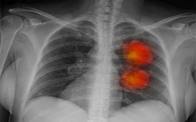 Рак легенів: симптоми і ознаки