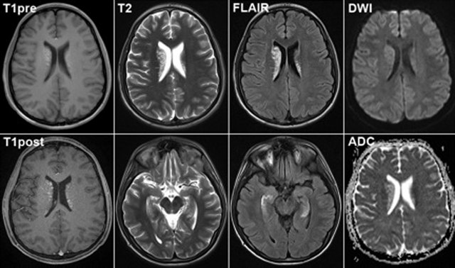 Як робиться МРТ головного мозку