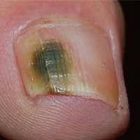 Лікування грибка нігтів народними засобами
