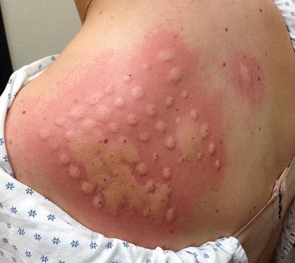 Як дізнатися, на що проявляється алергія, особливо лабораторних алергічних тестів