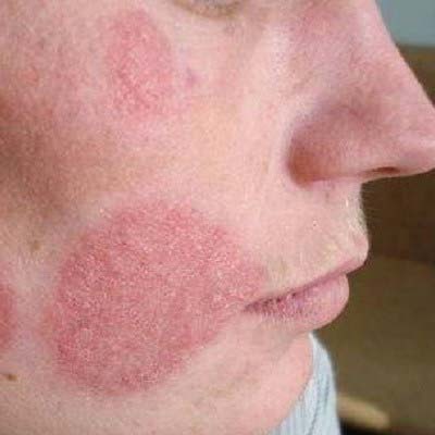 Себорейний дерматит (жирна екзема) на обличчі: причини розвитку, лікування та профілактика