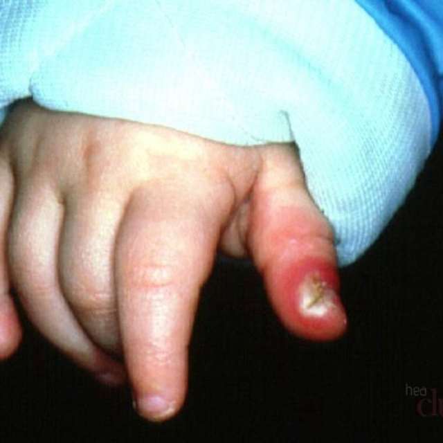 Способи лікування панарицію пальця на руці