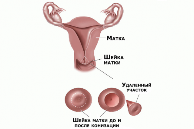 Рак шийки матки: ознаки і симптоми