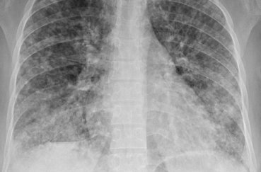 Рентгенографія грудної клітки: показання та протипоказання