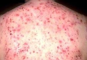 Себорейний дерматит: симптоми, причини виникнення, методи лікування