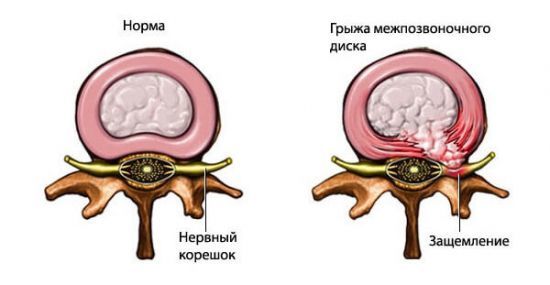 Симптоми защемлення нерва в попереку і лікування