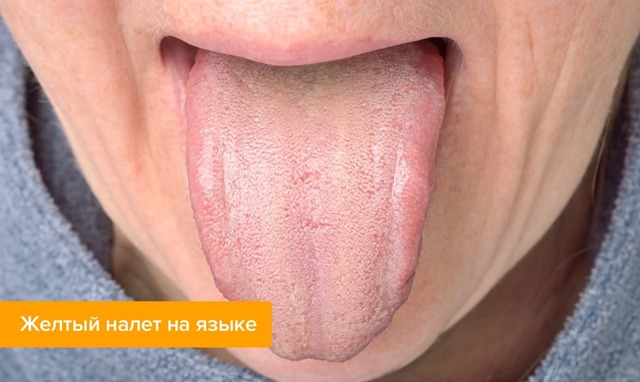 Білий і жовтий наліт на язику дорослих, причини та поради