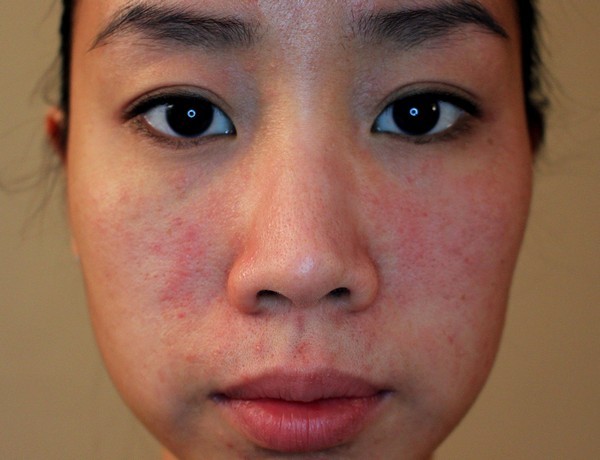 Особенности аллергии на лице, причины, методы лечения, аллергия на лице у детей