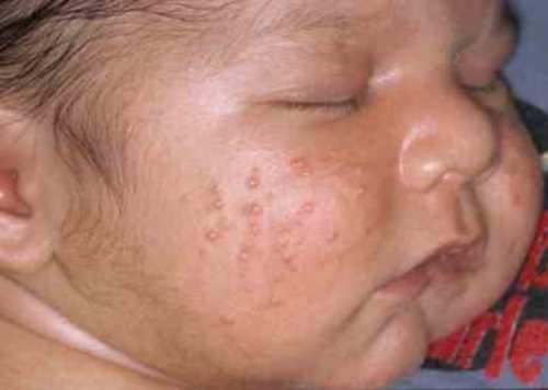 Як виражається алергія у дорослих і дітей, причини і симптоми хвороби