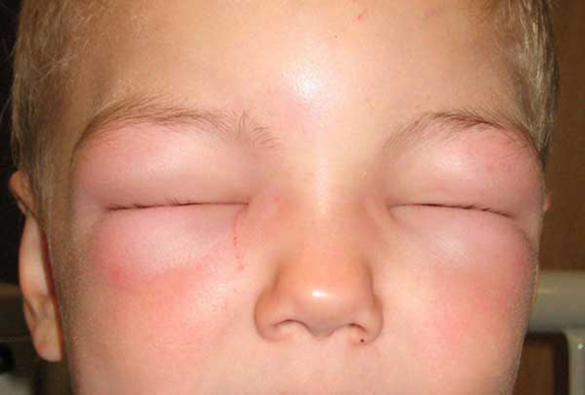 Симптоми і способи лікування алергії на холод