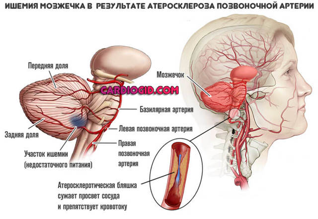 Атеросклероз судин головного мозку симптоми і лікування