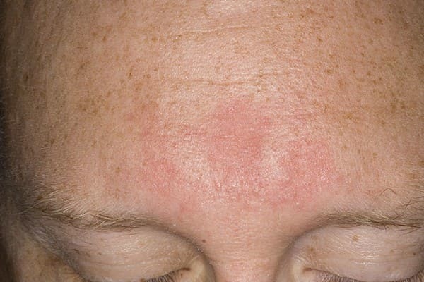 Себорейний дерматит (жирна екзема) на обличчі: причини розвитку, лікування та профілактика
