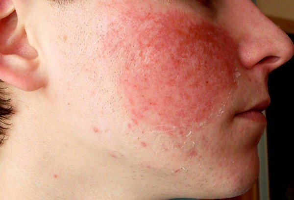 Особливості алергії на обличчі, причини, методи лікування, алергія на обличчі у дітей