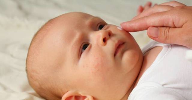 Диатез у новорожденных на лице: лечение