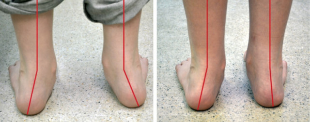 Ортопедичне взуття при вальгусной деформації