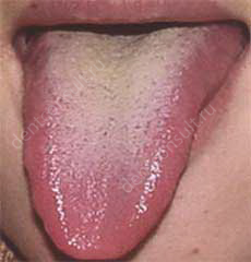 Білий і жовтий наліт на язику дорослих, причини та поради