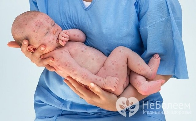 Вітрянка у новонароджених і грудних дітей - фотографії, симптоми, лікування