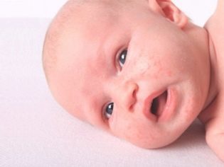 Яка буває висип на обличчі у новонародженого
