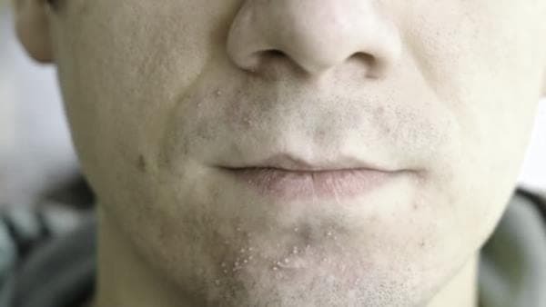 Прищі після гоління: причини появи і способи боротьби