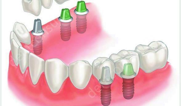 Імплантація зубів: протипоказання і можливі ускладнення