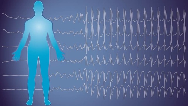 Симптомы эпилепсии: причины и проявления