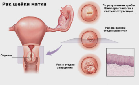 Рак шийки матки: ознаки і симптоми