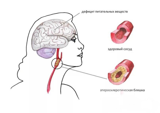 Атеросклероз судин головного мозку симптоми і лікування