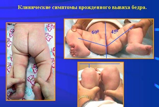 Лікування вродженої дисплазії кульшових суглобів у немовлят