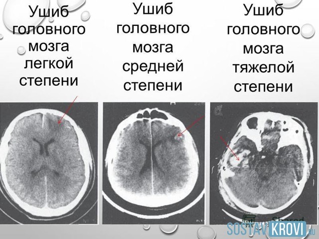 Що таке забій головного мозку