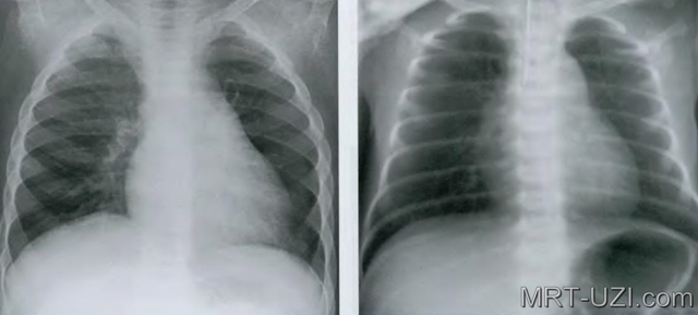 Флюорографія і рентген легенів: в чому різниця