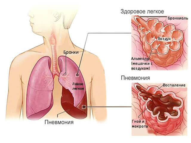 Як лікувати кашель при раку легенів, причини, симптоми