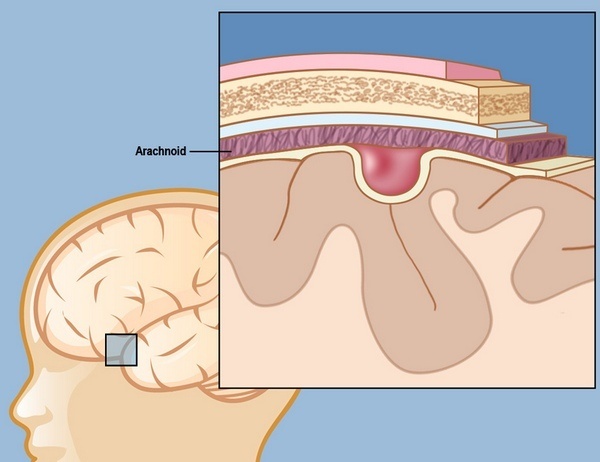 Кіста головного мозку у новонародженого