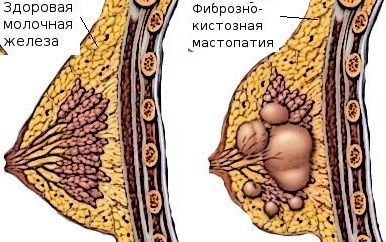 Дифузна фіброзно-кістозна мастопатія молочних залоз
