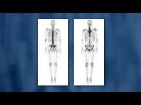 Сцинтиграфія кісток скелета: прогресивний метод діагностики