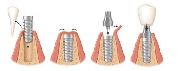 Имплантация зубов: противопоказания и возможные осложнения