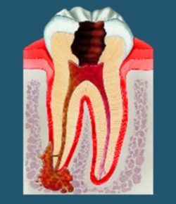 Возможно ли лечение кисты зуба без удаления