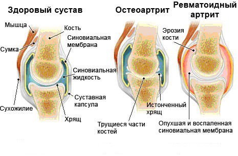 Застосування метотрексату при ревматоїдному артриті
