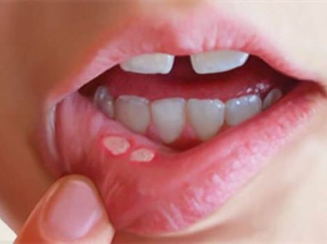 Прыщ на губе: как избавиться, причины появления