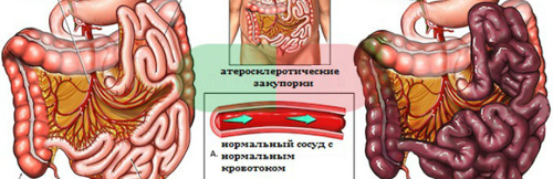Симптоми і лікування ішемії кишечника
