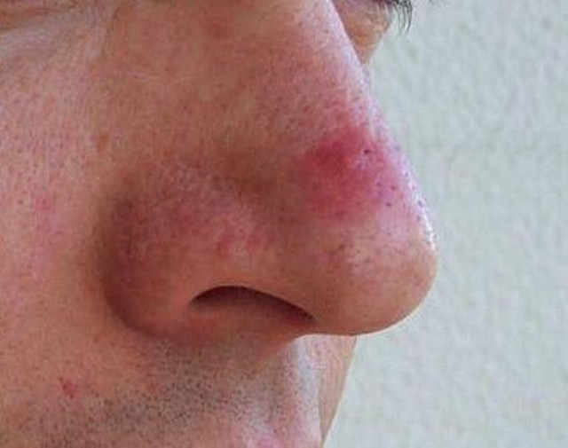Прищі на носі: причини появи, лікування та профілактика