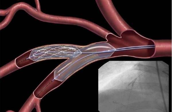 Ишемическая болезнь и стентирование сосудов сердца