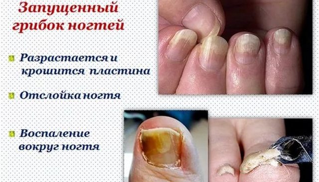 Лікування грибка нігтів народними засобами